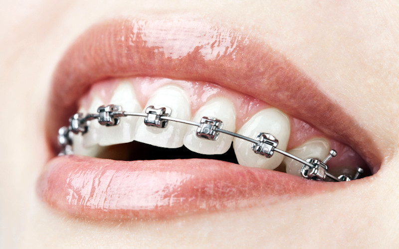Traditional or metal brackets