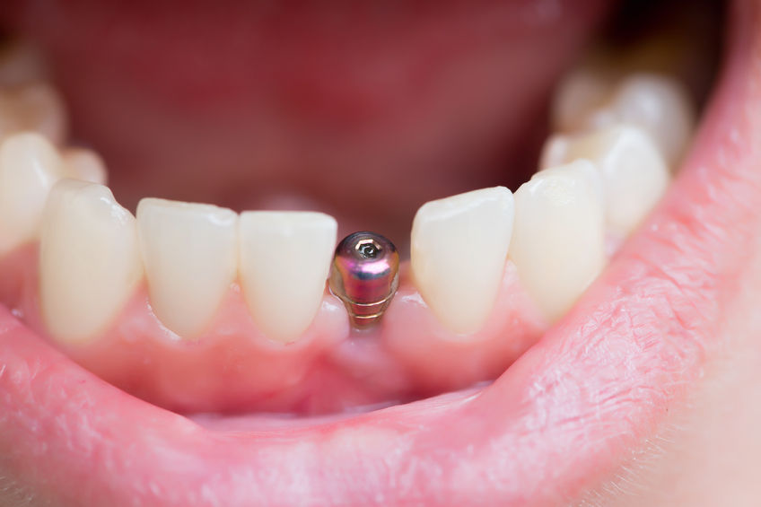 Postoperatorio implantes dentales y tiempo de recuperación