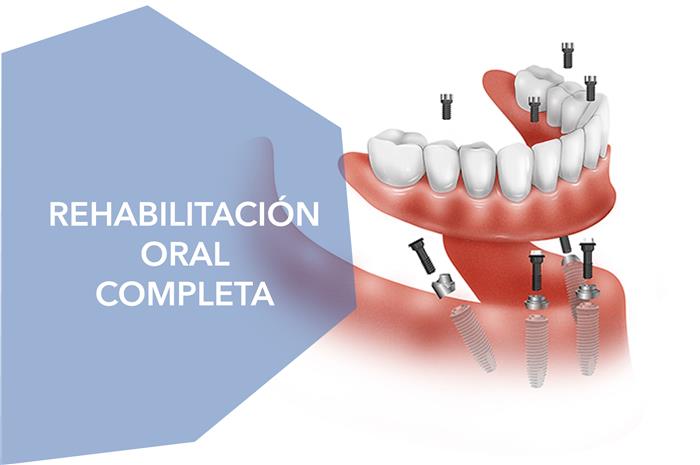 Rehabilitación oral completa