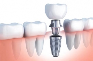 ¿Un implante se siente como un diente natural?