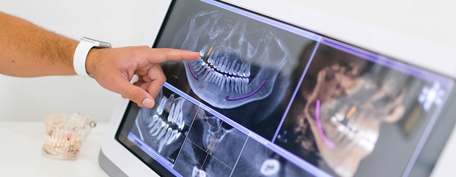¿Qué pruebas hacen antes de decirdir hacer un implante?
